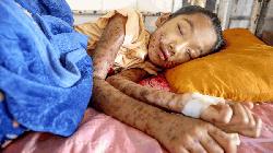 94 child deaths from measles in 19-day: DGHS