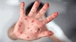 2 children die of measles symptoms in Khulna