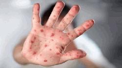 One more suspected measles death recorded in Bangladesh