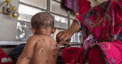 Five more children die of measles symptoms