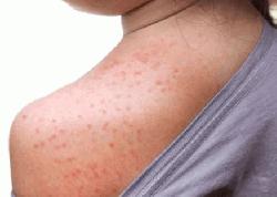 Three more die with measles symptoms
