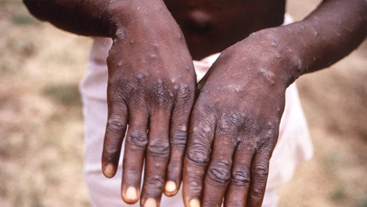 An image created during an investigation into an outbreak of monkeypox, which took place in the Democratic Republic of the Congo (DRC), 1996 to 1997, shows the hands of a patient with a rash due to monkeypox. Photo: Reuters 